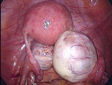 эндометриома правого яичника