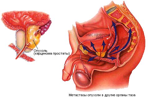 prostata_tumor